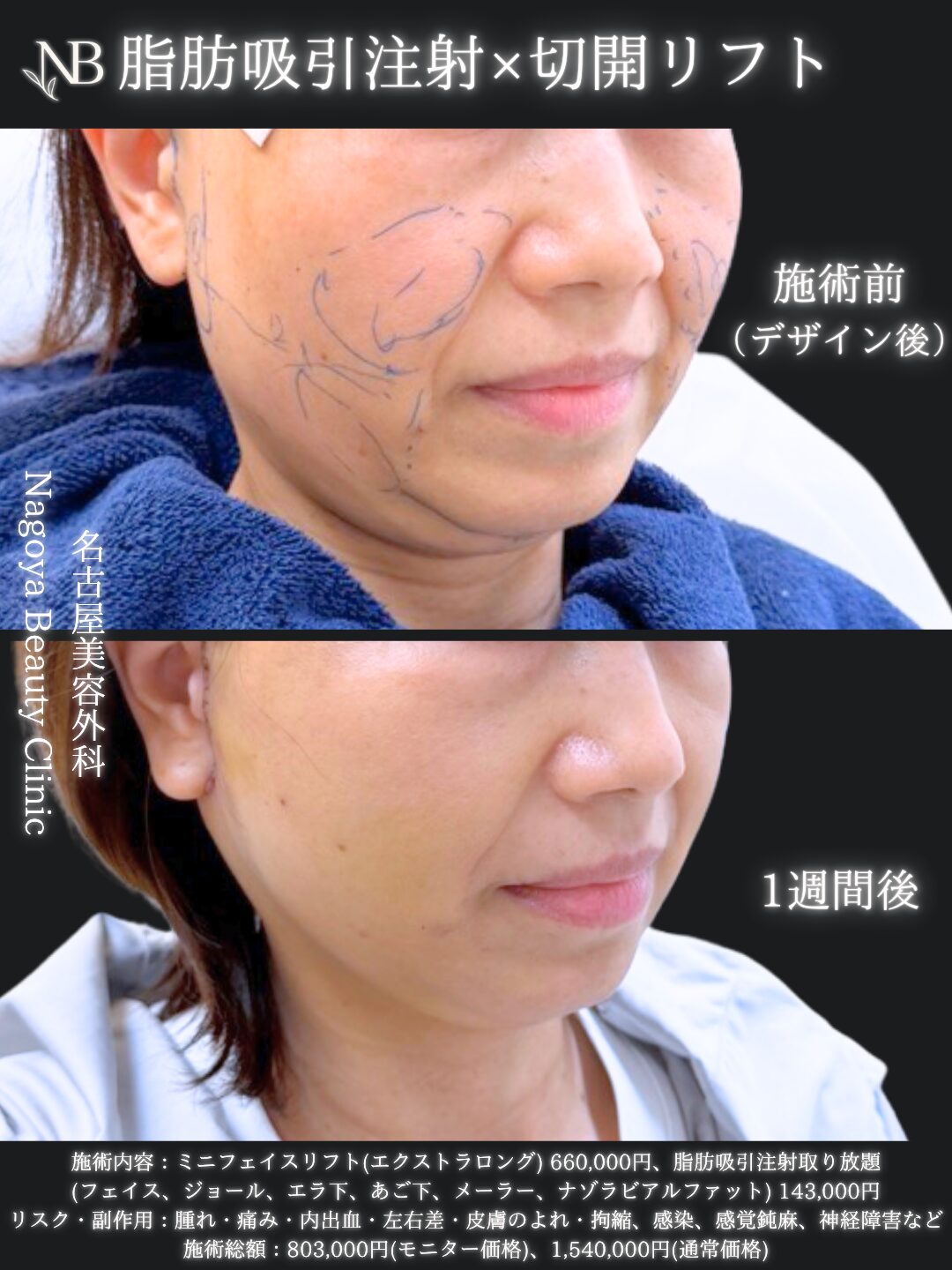 切開リフト×脂肪吸引注射